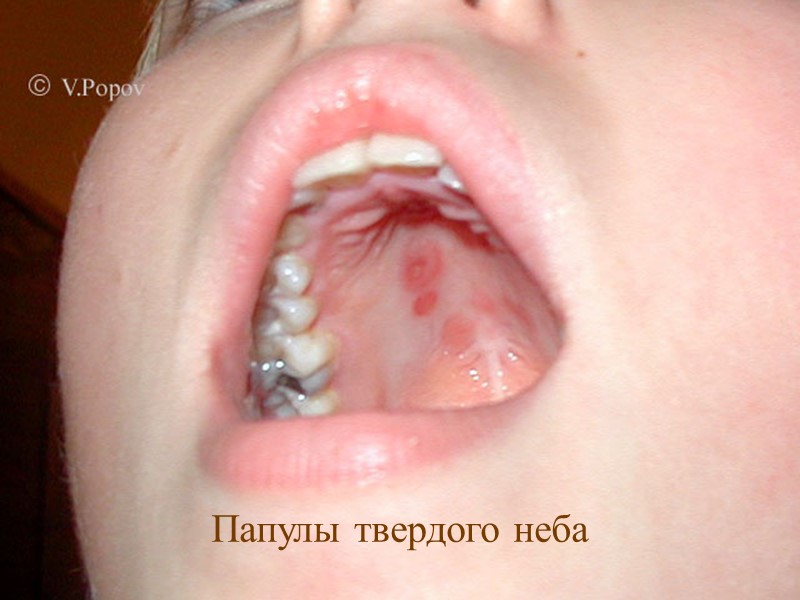 Папулы твердого неба